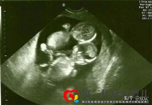 多年不孕,成都三代试管一次成功双胎男宝(图5)
