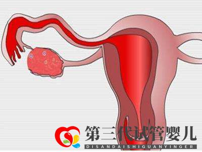 子宫肌瘤做俄罗斯试管婴儿的成功率高吗？(图2)