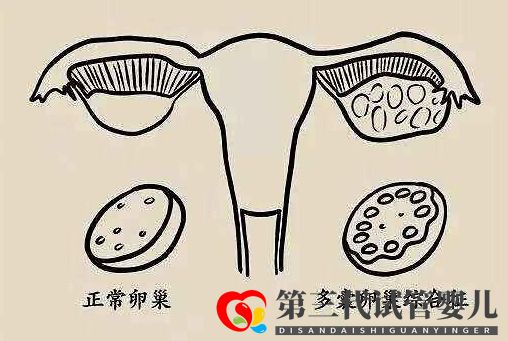 多囊促排怀孕成功率大吗?(图1) 多囊促排怀孕成功率大吗?(图1)