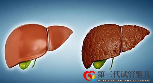 老年肝硬化的原因有哪些?医生:多数可以避免(图1) 老年肝硬化的原因有哪些?医生:多数可以避免(图1)