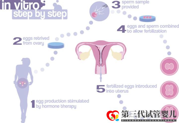 试管婴儿1代、2代、3代、4代哪个最好真实操作过...(图4)