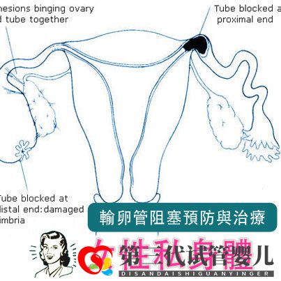 输卵管堵塞,怀孕到底有多难(图3)