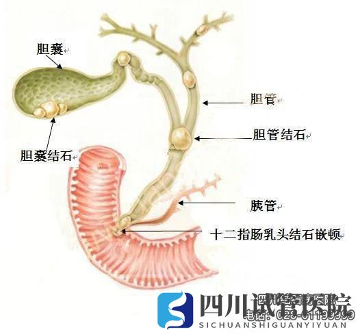 四川结石病医院等级专业品牌平价透明费用统一规范(图3)