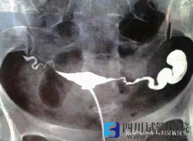 输卵管究竟通不通2分钟教你看懂输卵管造影片子(图4)