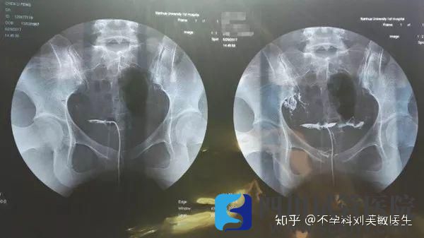 输卵管究竟通不通2分钟教你看懂输卵管造影片子(图2)